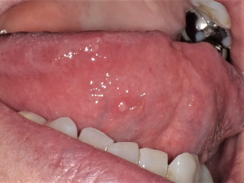 舌 の 側面 口内炎