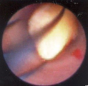 endoscopic-surgery_img11