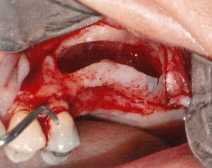endoscopic-surgery_img16