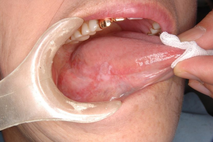 歯科医師が口腔癌を早期に発見するための診察法とコツ 新谷悟の歯科口腔外科塾