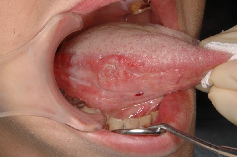 口腔・舌病変をみる-初期病変も見逃さないポイント- (MB ENTONI(エントーニ))