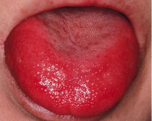 舌 痛い