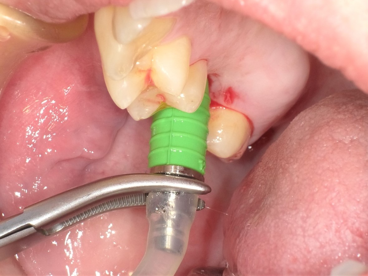 歯科インプラントSCAKIT | www.bbafasteners.com