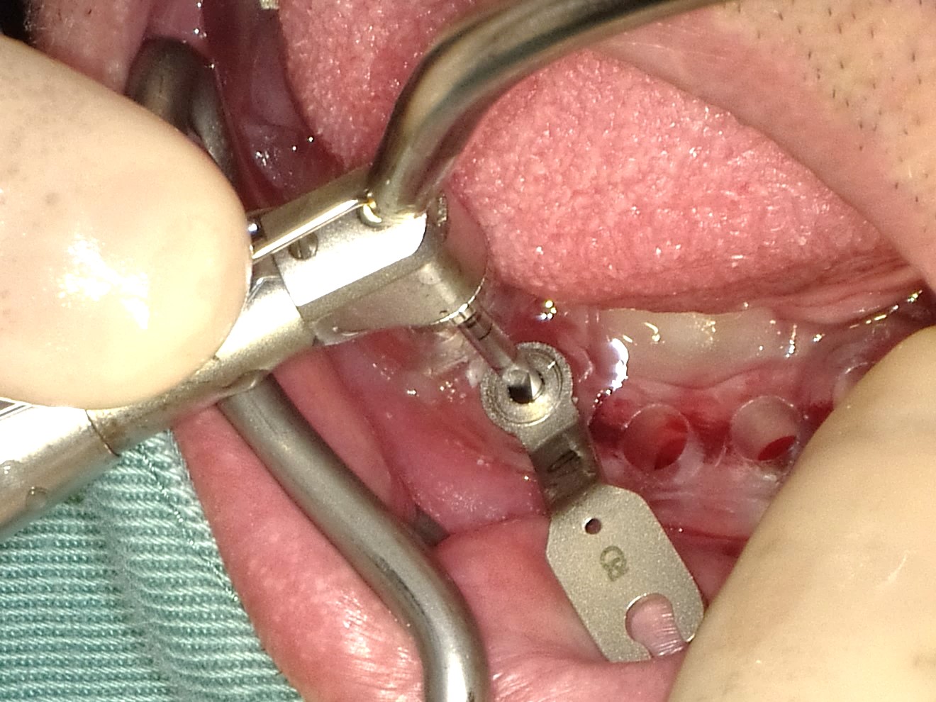 下顎無歯顎インプラント症例ケース03 - 新谷悟の歯科口腔外科塾
