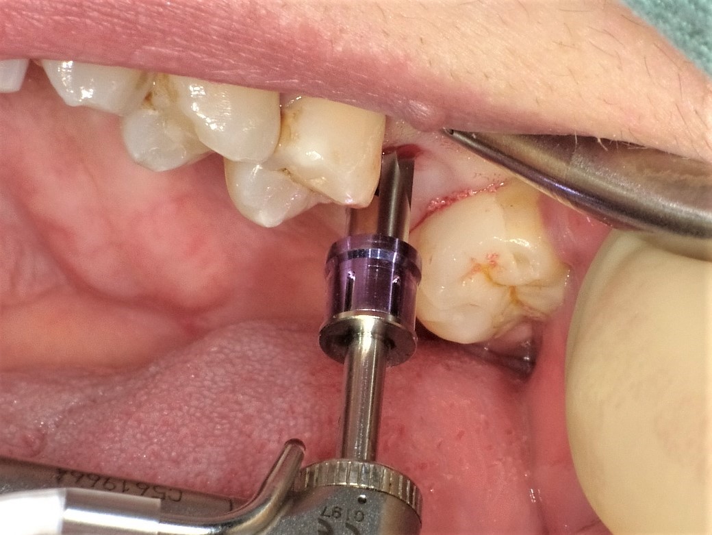 ソケットリフトにて骨造成したインプラント症例ケース02 左側上顎第1大臼歯の歯牙破折症例