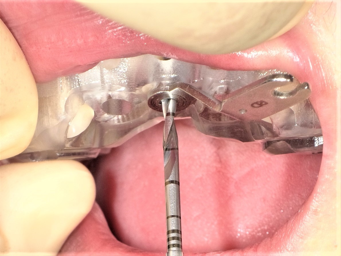 手術 歯根 嚢胞