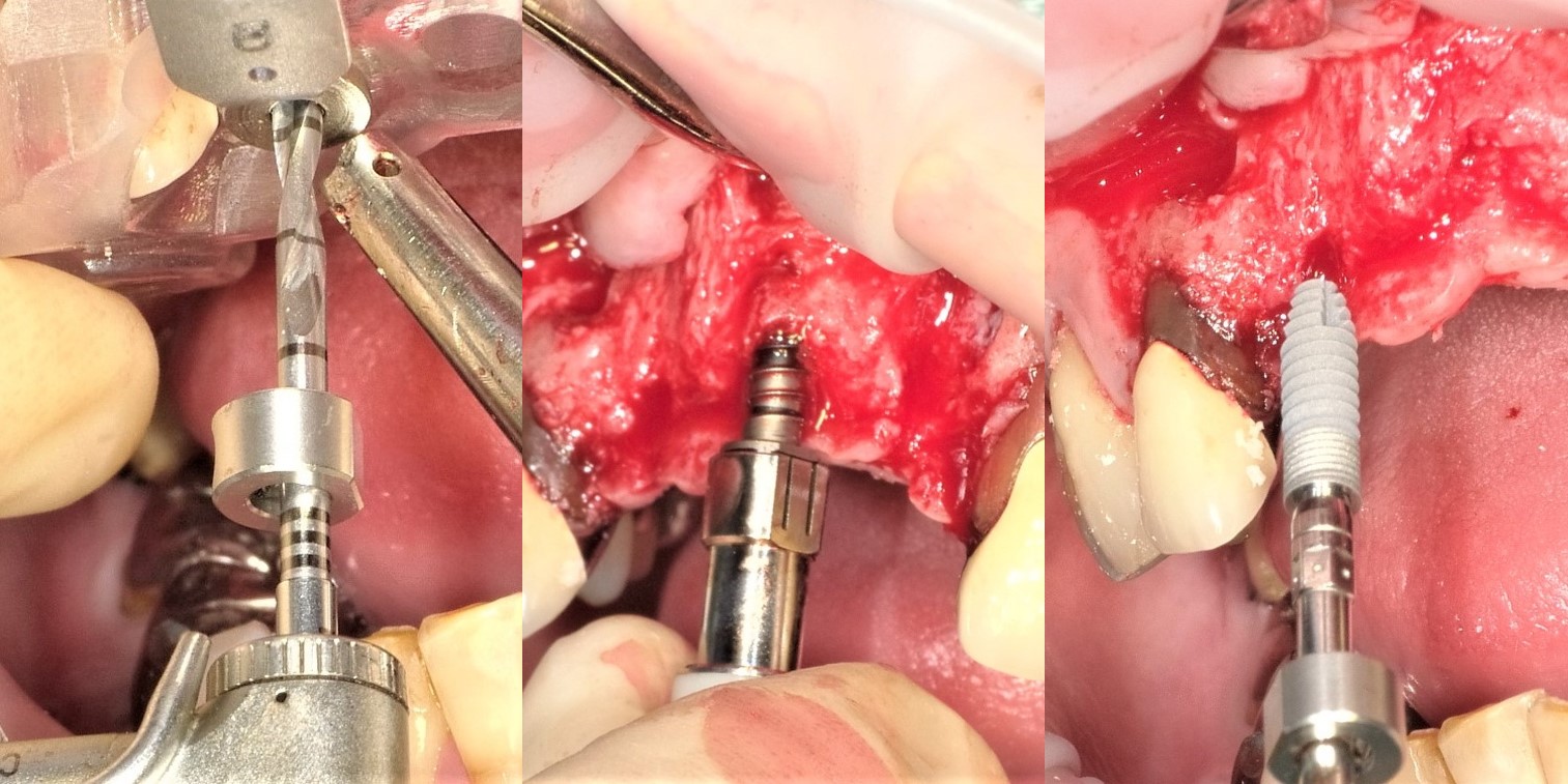 嚢胞 手術 歯根