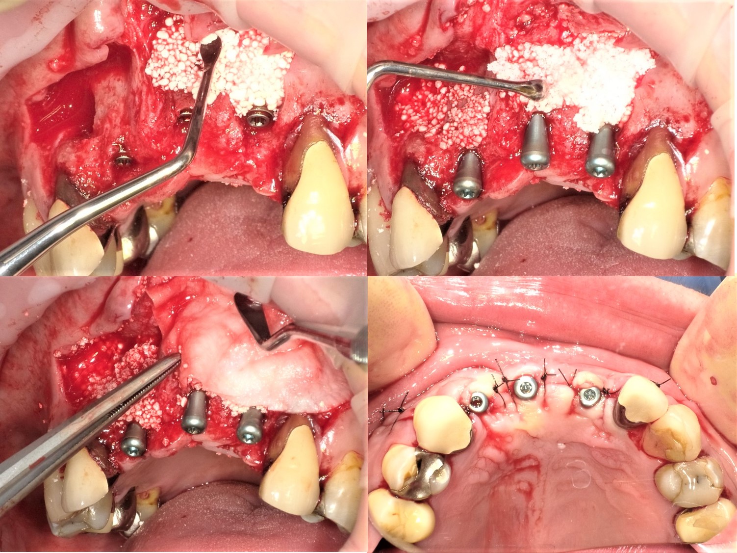 嚢胞 手術 歯根
