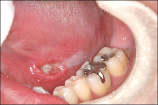 口内炎 カンジダ 性 歯ぐきにできる口内炎の種類と対処法